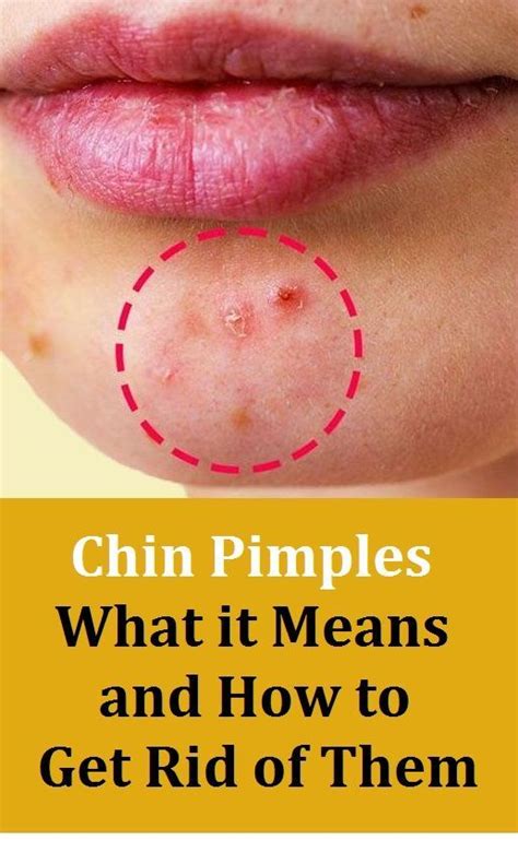 Pimples On The Chin What It Means And How To Get Rid Of Them Pimples