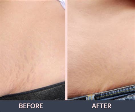 Scar Removal Spider Veins Stretch Marks Vina Laser Med Spa