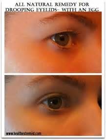 We did not find results for: Natural Remedy For Drooping Eyelids, Sagging Eyelids Or Hooded Eyes - FITNESS SHORTCUT