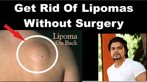 How To Get Rid Of Lipomas Naturally Youtube