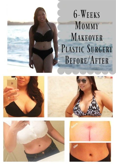 6 Weeks Post Op Mommy Makeover Plastic Surgery Before And After Results