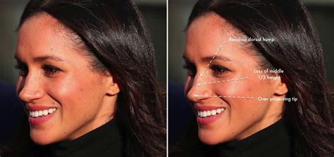 Megan Markle Plastic Surgery A Shirley Mclaughlin