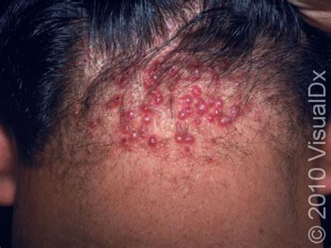 Nasty Bumps On The Back Of Your Head What Are They And How To Get Rid