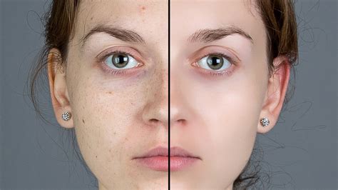 Check spelling or type a new query. How to Quickly Smooth Skin and Remove Blemishes & Scars ...