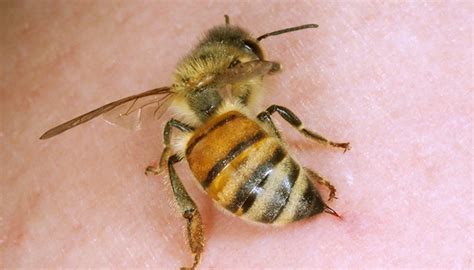 How To Treat Bee Stings What To Do For Bee Stings