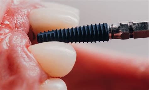 Understanding The Osseointegration Process Garran Dental