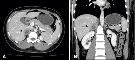 Preoperative Abdominal Contrast Enhanced Ct Scan Showed A Download