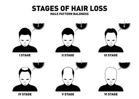 Male Pattern Baldness Hair Plus International