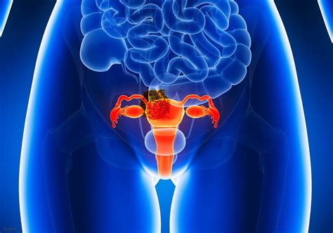 Cancer Lump On Cervix