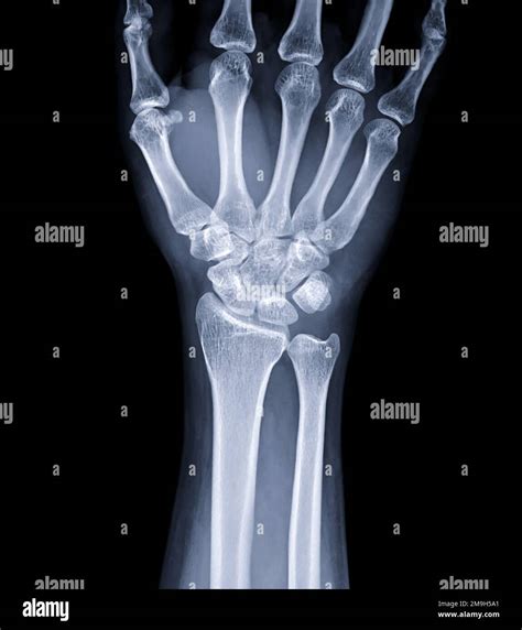 X Ray Image Of Wrist Joint For Diagnosis Rheumatoid Arthritis Stock