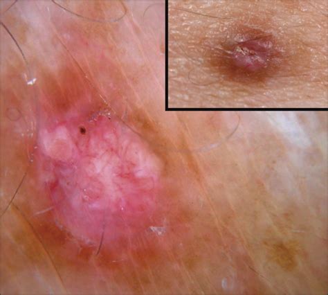 The Dermoscopic Differential Diagnosis Of Yellow Lobularlike Structures