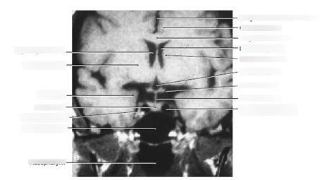 Coronal MRI Through Amygdala Optic Chiasm Infundibulum And Internal