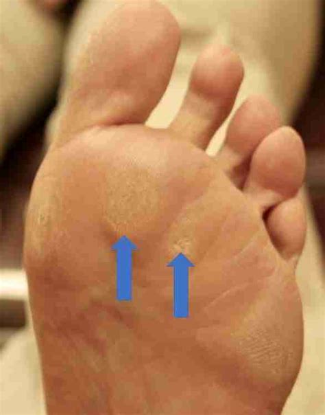 Ball Of Foot Pain Causes Symptoms Treatment And Insoles
