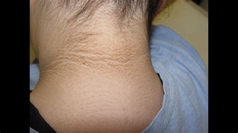 Acanthosis Nigricans Epi 452 Youtube