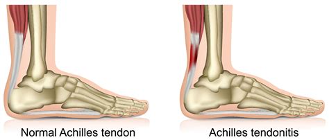 Bike Radar: What Causes Achilles Pain