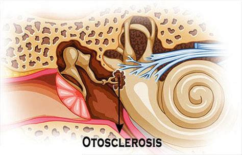 What Otosclerosis Is Blog Of Kiversal
