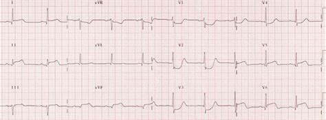 How To Read A 12 Lead Ecg For Dummies