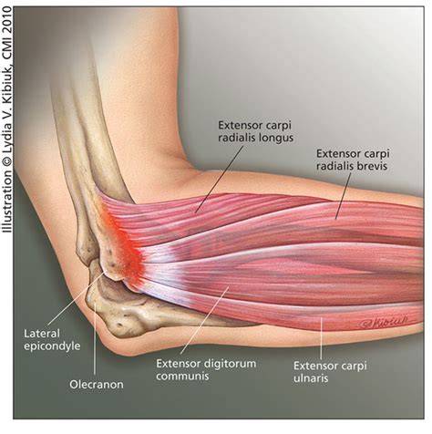 Traditional Conservative Treatments For Tennis Elbow Hss