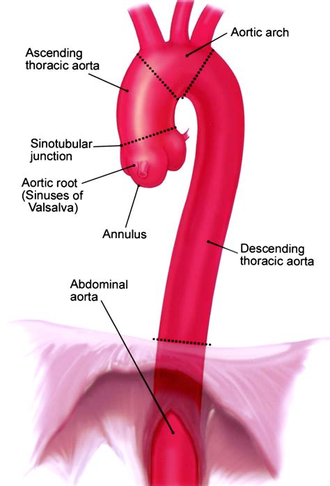 Abdominal Aorta Distal Proximal Yahoo Image Search Results