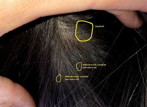 Top 48 Image What Does Lice Look Like In Hair Vn
