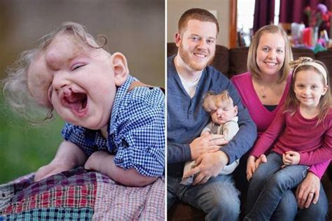 Baby Boy Born Without A Skull Defies Doctors To Live To Celebrate His