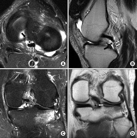 A Axial Fat Suppressed T2 Weighted Mr Image And B Sagittal Turbo