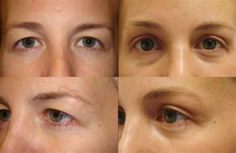 Endoscopic Brow Lift Dr Guy Massry