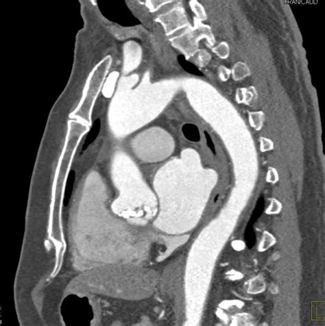 Bicuspid Calcified Aortic Valve With Aortic Stenosis Cardiac Case