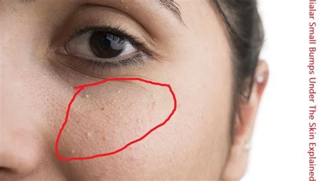 Milialar Small Bumps Under The Skin Explained Sukıtır