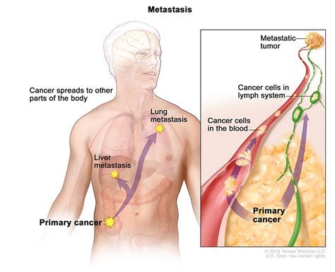 What are the signs and symptoms of colon cancer? Metastatic Cancer - National Cancer Institute