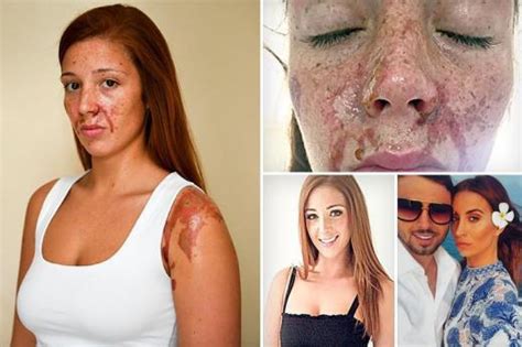 Nightclub Acid Attack Victim Bares Her Horrific Scars And Relives Terrifying Moment She Saw