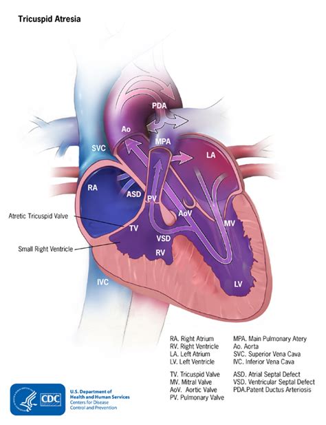 Congenital Heart Defects Facts About Tricuspid Atresia Cdc