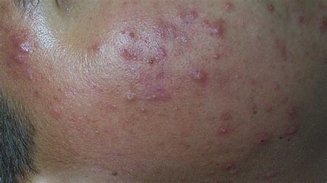 Download Nodular Acne Back Png Acne Problems