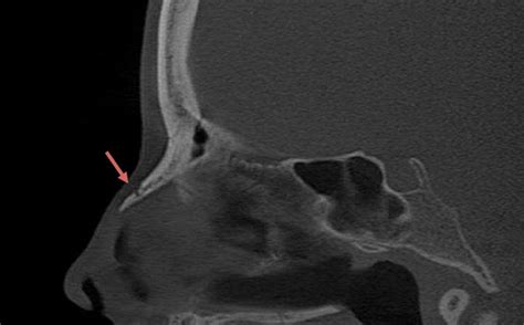 Nasal Bone Xray