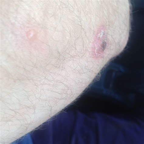 Small Itchy Blisters Appearing On Arm Turning Into Sores Doctor