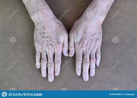 Age Spots On Hands Of Asian Elder Man They Are Brown Gray Or Black