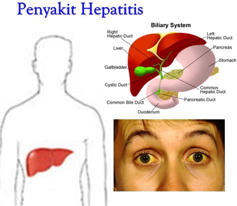 Pemeriksaan keparahan penyakit didasarkan penilaian pemeriksaan jasmani, ast, alt, ggt, alp, bilirubin menilai komorbid atau penyakit pemberat pada hepatitis b kronik. Cara Ampuh Atasi Penyakit Hepatitis Dengan Melia Propolis ...