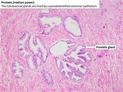 Prostate Normal Histology Nus Pathweb Nus Pathweb