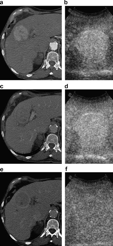 Enhancement Patterns Of Hcc At Contrast Enhanced Us And Download