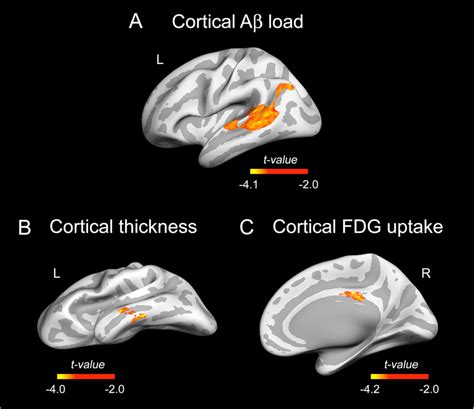 Association Of Slf With Cortical Aβ Load Cortical Thickness And Download Scientific Diagram