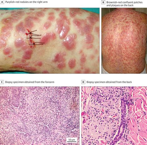 Disseminated Red Violaceous Papulonodular Lesions Dermatology Jama