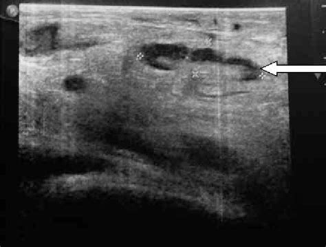 Inguinal Lymph Node Ultrasound