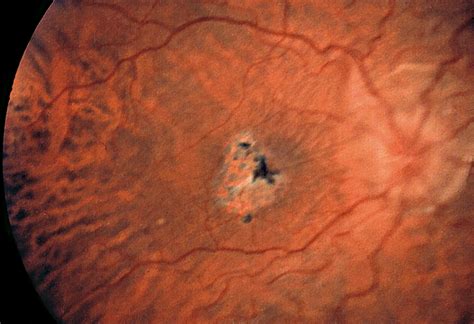 Ocular Hypotony Secondary To Spontaneously Ruptured Posterior