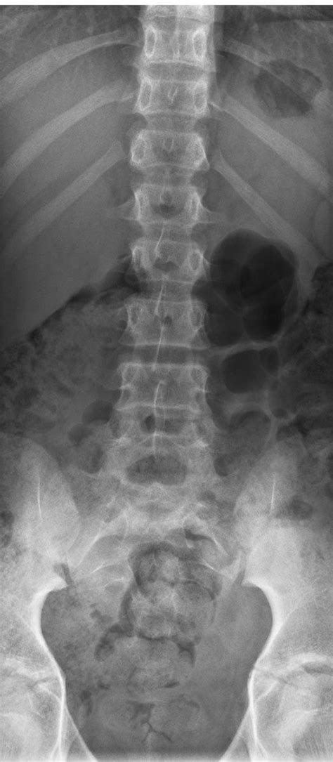 Learn vocabulary, terms and more with flashcards, games and other study tools. Antero-posterior X-ray lumbar view. Note the absence of ...