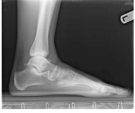 Lateral Ankle X Ray Showing Large Talar Osteophyte In Patient With