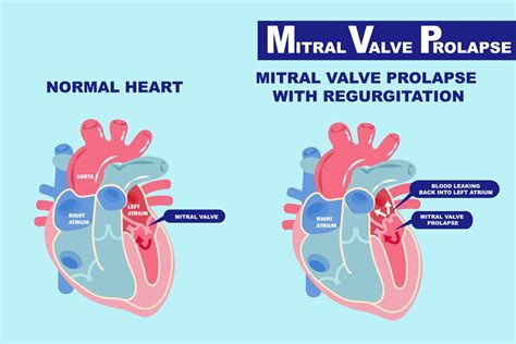 What You Need To Know About Mitral Valve Prolapse