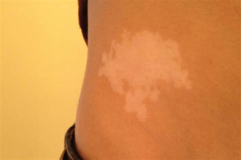 White Birthmark Spiritual Meaning 9 Messages For You