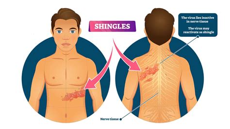 Doctors Explain The Causes And Symptoms Of Shingles