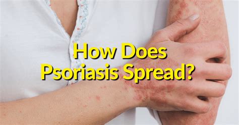 How Does Psoriasis Spread The Office Of Dr Brad Shook Dc