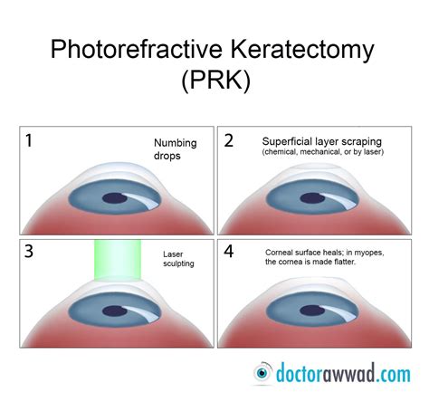 Prk Photorefractive Keratectomy Is A Type Of Refractive Surgery To